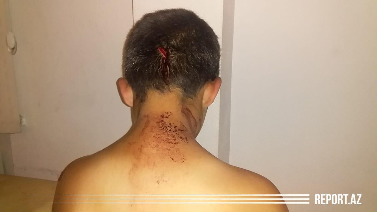 Ata dilənmək istəməyən 11 yaşlı oğlunu başından bıçaqladı - FOTO